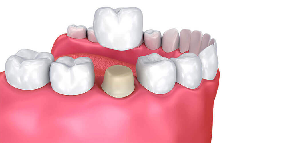 Dental Crowns North Vancouver