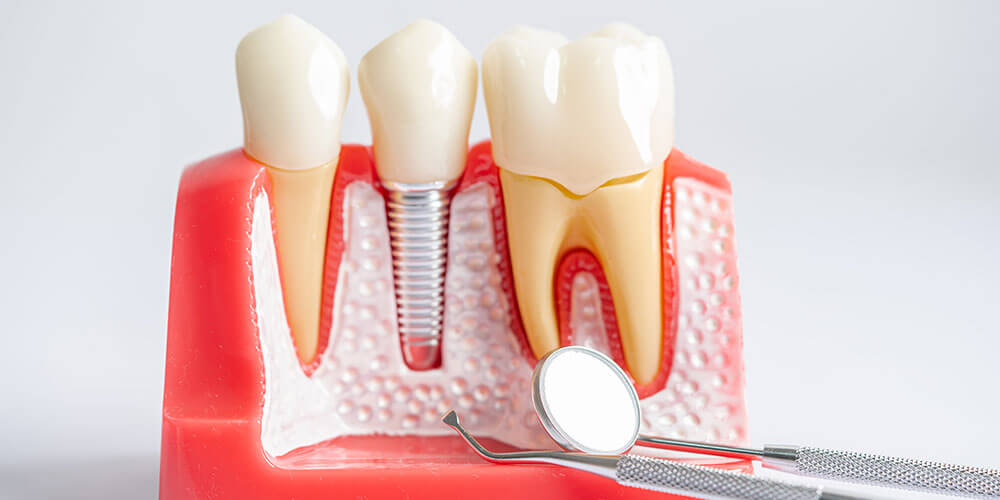 Dental Implants North Vancouver