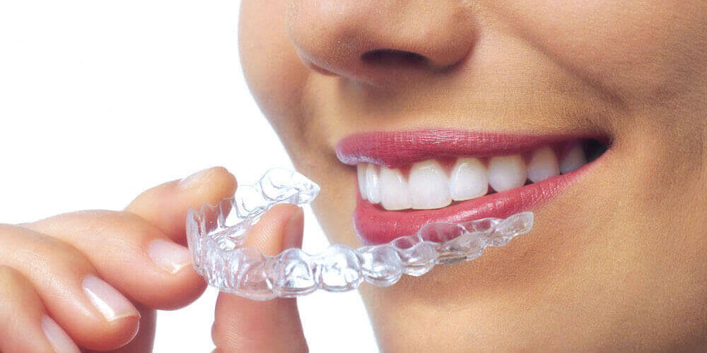 Invisalign and clear aligners North Vancouver