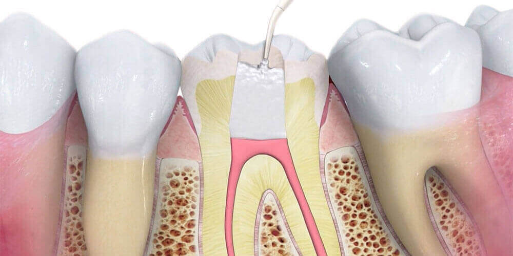 Surgical root canal therapy North Vancouver